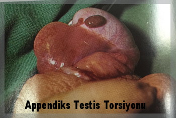 appandiks testis torsiyonu