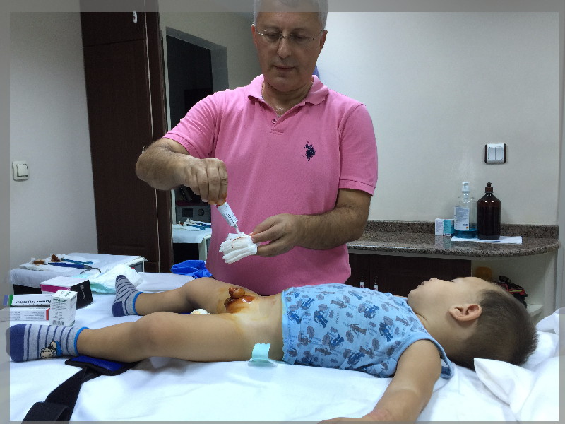 Sandviç Pansuman Uygulaması Antalya Çocuk Cerrahi