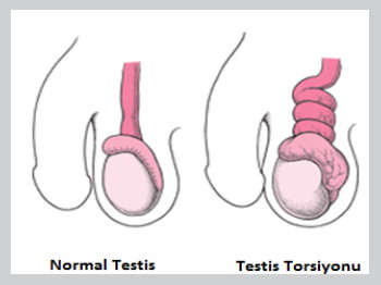 testis torsiyonu